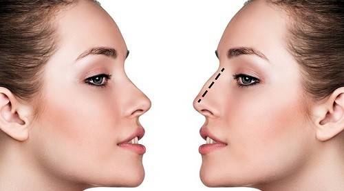 CÓ NÊN PHẪU THUẬT THẨM MỸ KHÔNG VÀ LỜI GIẢI CHẤN AN DƯ LUẬN